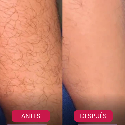 Depiladora de Cristal  ✨ DEPILACIÓN SIN DOLOR 💎 Piel Lisa y Suave por Más Tiempo