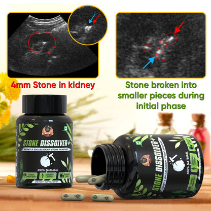 STONE DISSOLVER  🪨🔨 | Suplemento Renal para Cálculos e Infección